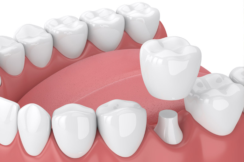 Dental Crowns in Corte Madera