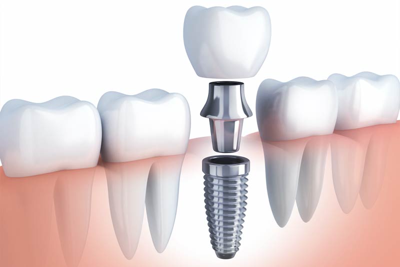 Implants Dentist in Corte Madera
