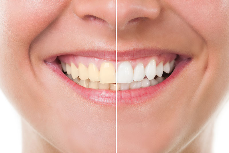 Teeth Whitening in Corte Madera