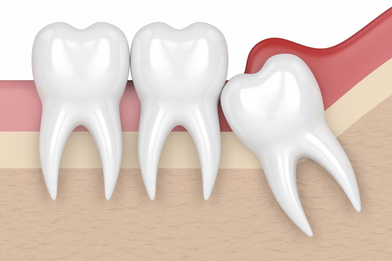 Wisdom Tooth Removal in Corte Madera